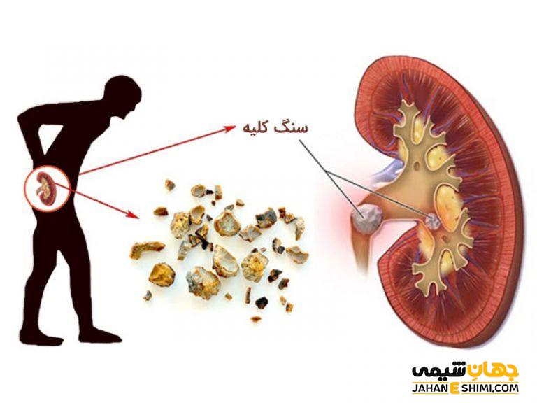 مانع از ایجاد سنگ کلیه می شود