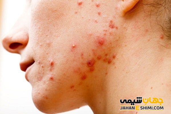 قرص و محلول و کپسول کلیندامایسین چیست؟