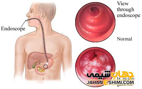 هلیکوباکتر پیلوری چیست؟ همراه با راه های تشخیص و درمان