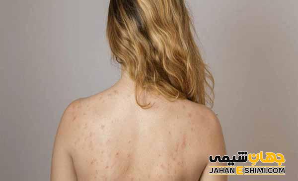 روش های درمان جوش کمر