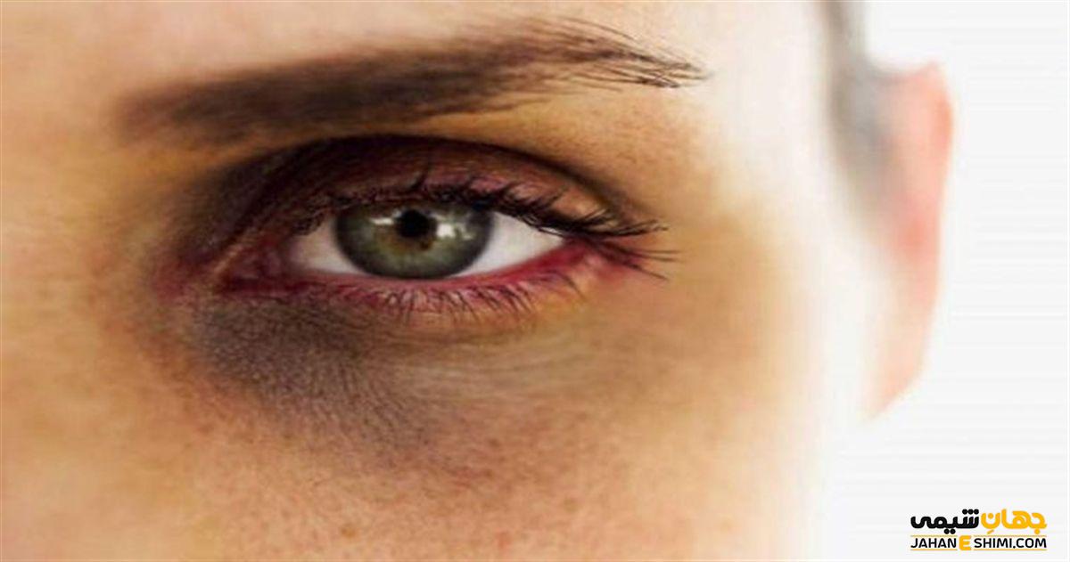 راهنمای خرید لوسیون دور چشم برای درمان سیاهی اطراف چشم