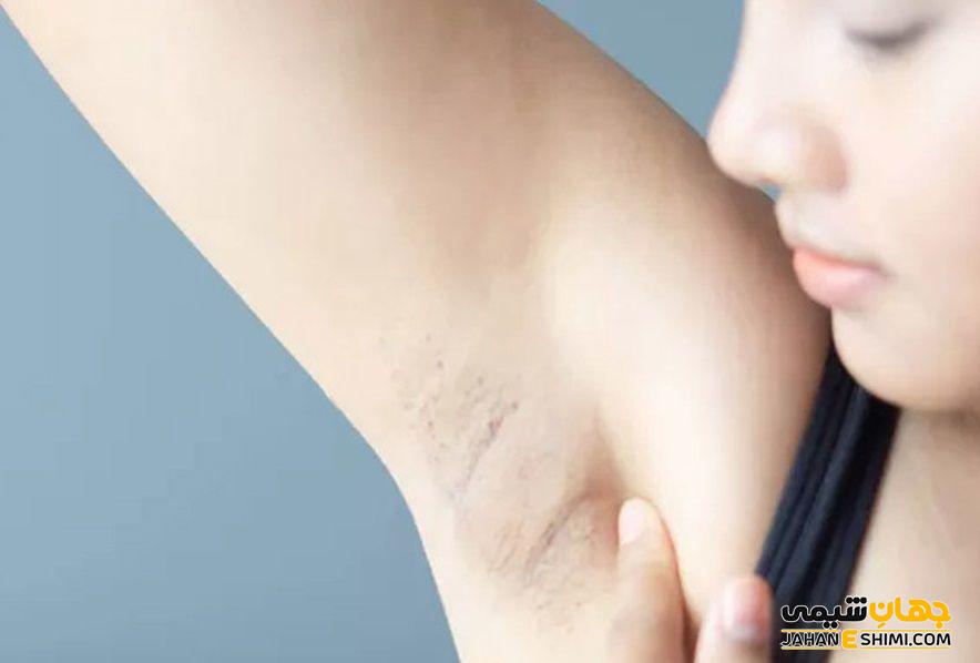 روش های پیشگیری از تیرگی زیر بغل