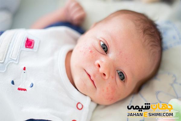 علل ایجاد لکه های شیر روی پوست نوزاد