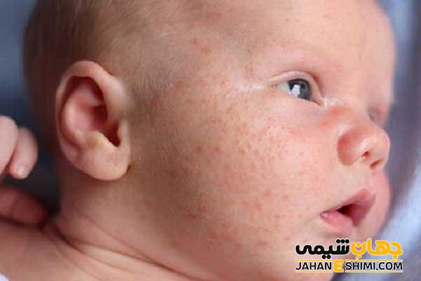 علل ایجاد لکه های شیر روی پوست نوزاد