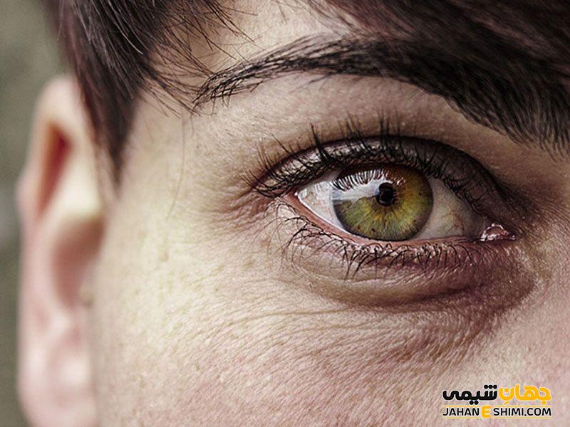 نوع تیرگی دور چشم