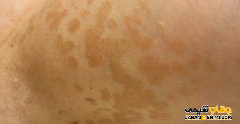 بیماری پوستی تینه آ ورسیکالر چیست؟ علل، علائم، تشخیص و درمان
