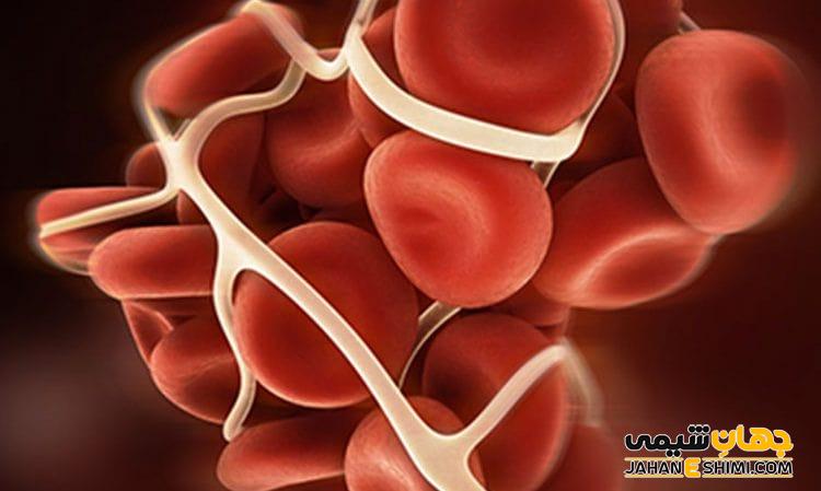 سندرم آنتی فسفولیپید چیست؟ علل، علائم، تشخیص و درمان آن