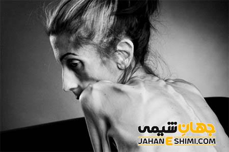 بی اشتهایی عصبی یا آنورکسیا چیست؟ علل، علائم، تشخیص و درمان آن