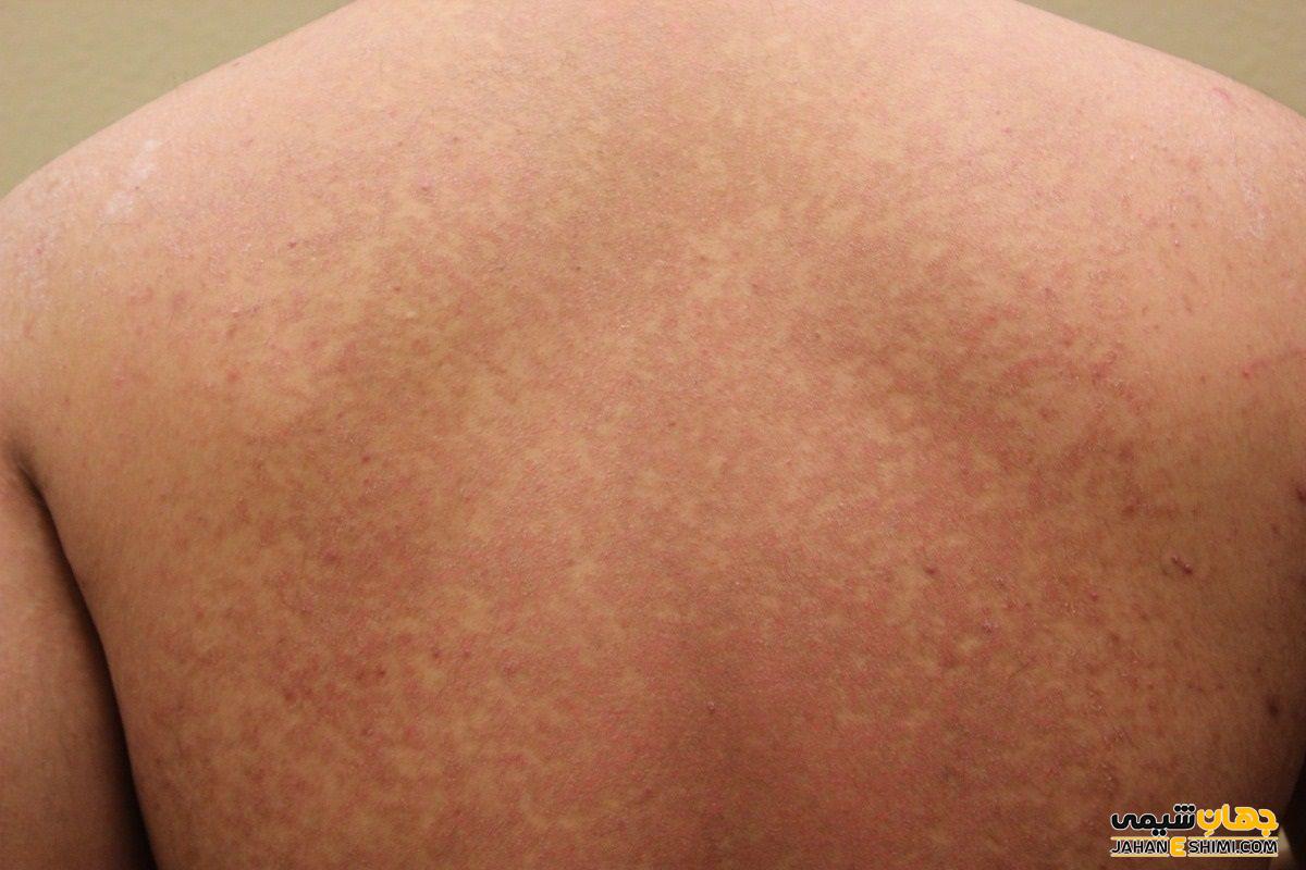 بیماری پوستی تینه آ ورسیکالر چیست؟ علل، علائم، تشخیص و درمان