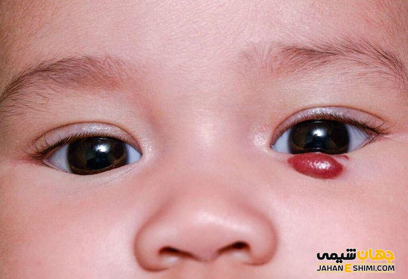 همانژیوم (Hemangioma) چیست؟ علل، علائم، تشخیص و درمان آن