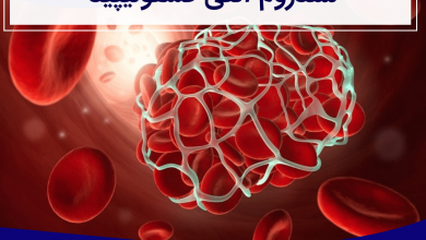 سندرم آنتی فسفولیپید چیست؟ علل، علائم، تشخیص و درمان آن