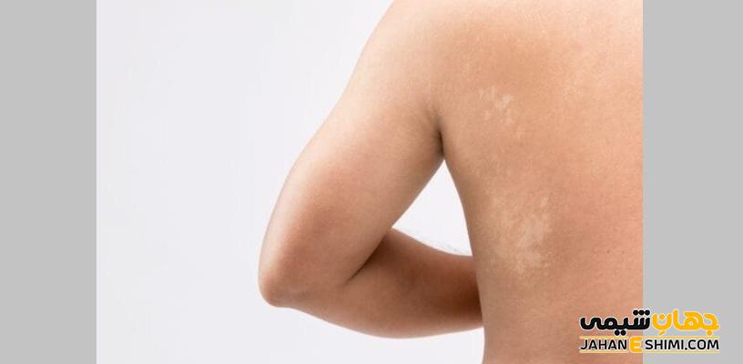 بیماری پوستی تینه آ ورسیکالر چیست؟ علل، علائم، تشخیص و درمان
