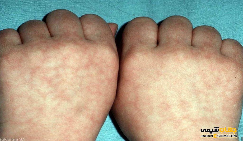 سندرم آنتی فسفولیپید چیست؟ علل، علائم، تشخیص و درمان آن