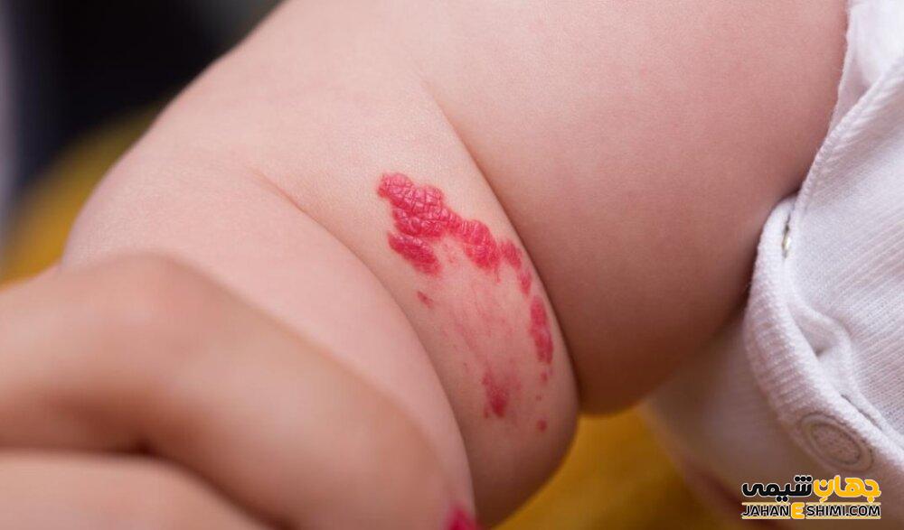 همانژیوم (Hemangioma) چیست؟ علل، علائم، تشخیص و درمان آن