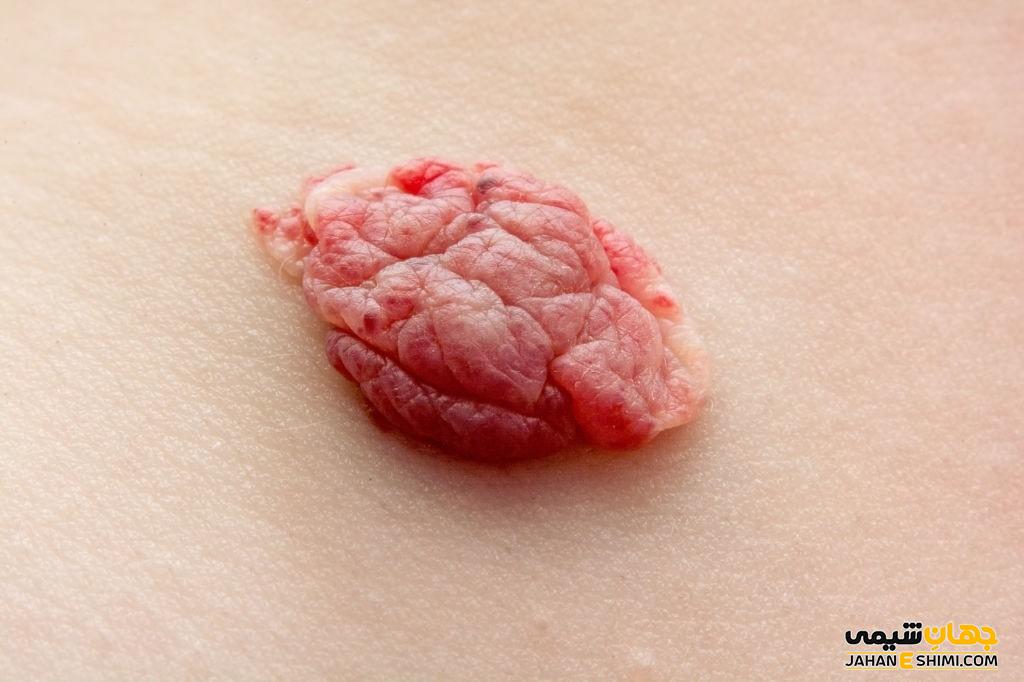همانژیوم (Hemangioma) چیست؟ علل، علائم، تشخیص و درمان آن