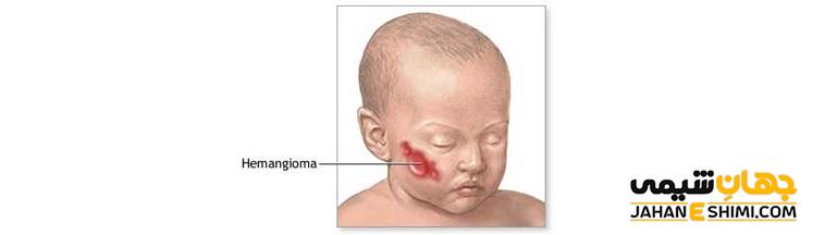 همانژیوم (Hemangioma) چیست؟ علل، علائم، تشخیص و درمان آن