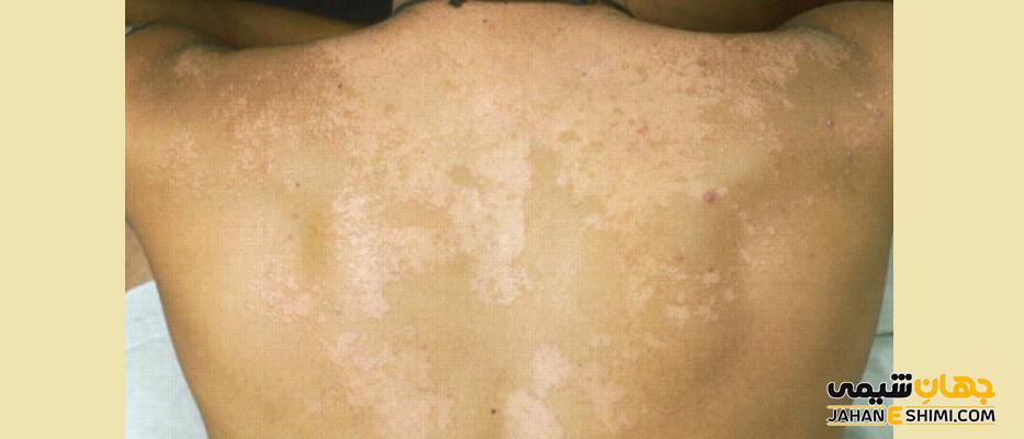 بیماری پوستی تینه آ ورسیکالر چیست؟ علل، علائم، تشخیص و درمان