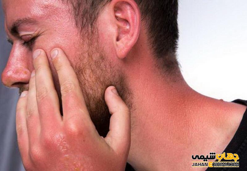 کرم و پماد آلفا چیست؟ معرفی، موارد مصرف و قیمت آن