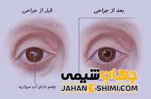 کپسول افتاویت چیست؟ آیا آب مروارید را درمان می کند؟