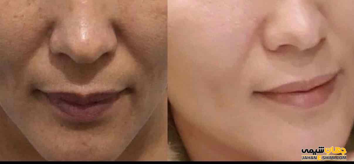 کپسول پیگمنتا درمکس چیست؟ از کاربرد تا عوارض آن