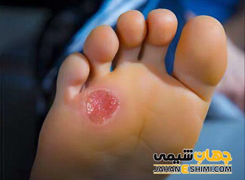 در درمان زخم پای بیماران دیابتی موثر است
