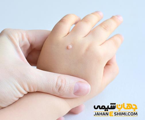 سوسپانسیون ضد میخچه و زگیل ادیب چیست؟ چه فوایدی دارد؟
