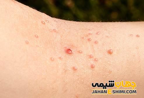 سوسپانسیون ضد میخچه و زگیل ادیب چیست؟ چه فوایدی دارد؟