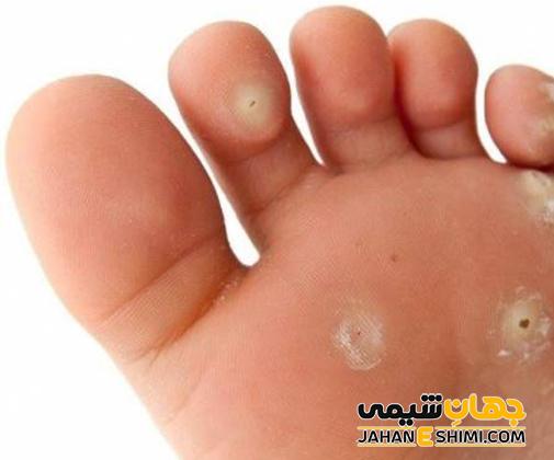 سوسپانسیون ضد میخچه و زگیل ادیب چیست؟ چه فوایدی دارد؟
