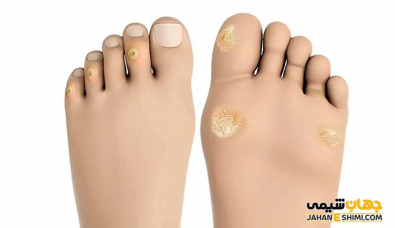 سوسپانسیون ضد میخچه و زگیل ادیب چیست؟ چه فوایدی دارد؟