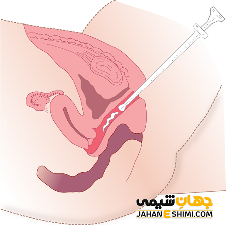 شیاف واژیتکس بانوان چیست؟ چه فواید و عوارضی دارد؟