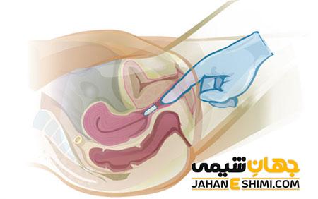 شیاف واژیتکس بانوان چیست؟ چه فواید و عوارضی دارد؟