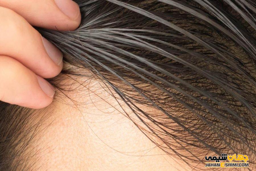 تاثیر قرص ایزوترتینوئین بر کاهش چربی مو و پوست سر