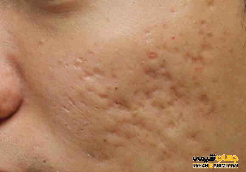 جای جوش قندیلی