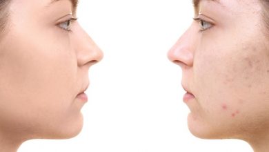 روش های دارویی و غیر دارویی درمان جای جوش