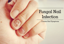 ضد قارچ ناخن چیست و چه کاربردی دارد؟ قیمت خرید و فروش