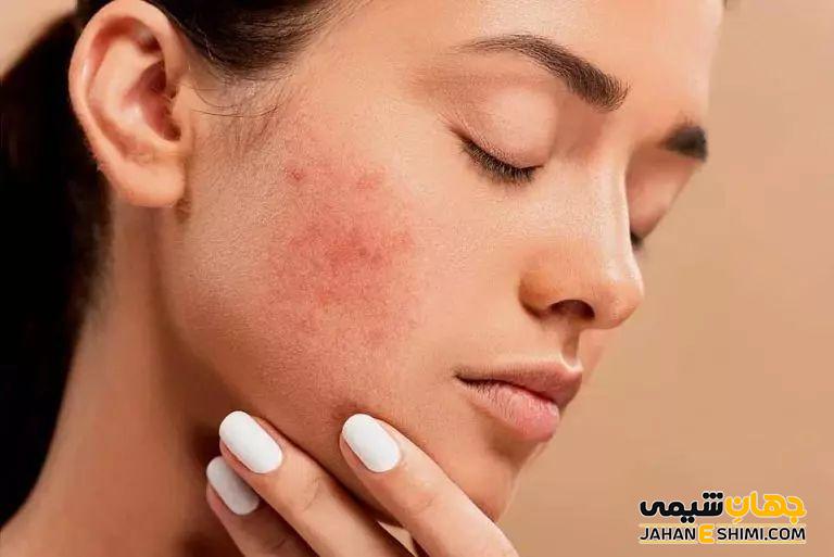 قرص تتراسایکلین برای درمان جوش صورت