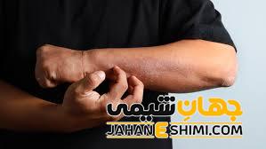 معرفی انواع قطره ضد قارچ پوستی نحوه مصرف و عوارض آن
