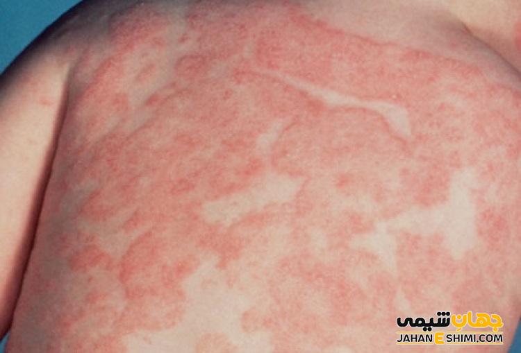 آلرژی به نور خورشید و نکاتی مهم که از آن نمی دانید! | حساسیت به نور آفتاب چیست؟