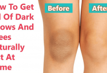 عوارض رفع تیرگی زانو با جوش شیرین  چیست؟