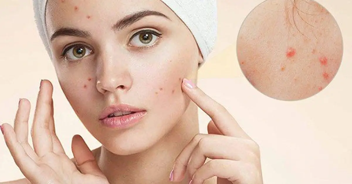 ماسک صورت برای جوش و روشن کننده