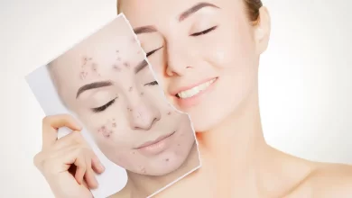 معرفی کرم از بین بردن لکه های قهوه ای جای جوش و اسکار
