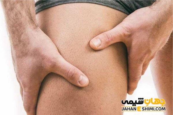 دیگر عوامل ایجاد کننده تيرگی كشاله ران