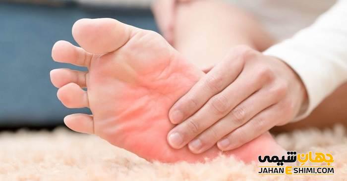 20 علت سوزش کف پا و درمان خانگی آن | دارو برای سوزش کف پا