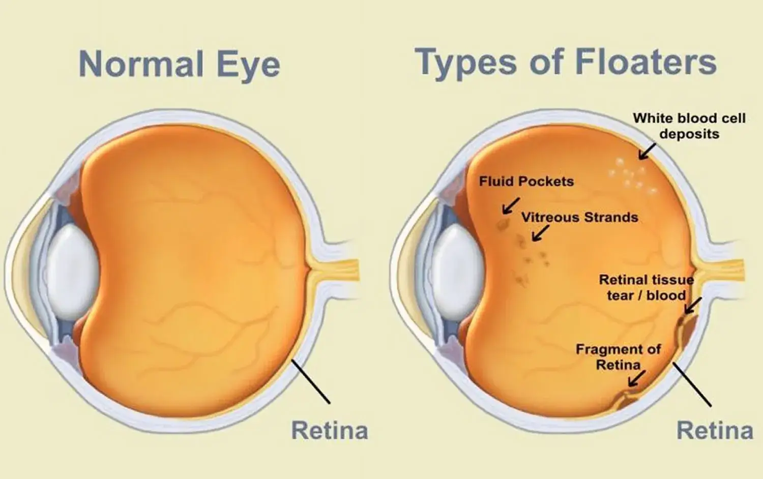 Что нельзя делать при глаукоме. Здоровый глаз и глаукома. Зрение при глаукоме.