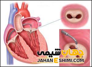 افتادگی دریچه قلب چیست؟ | دارو و درمان قطعی افتادگی دریچه قلب