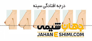 5 دلیل مهم افتادگی سینه | درمان قطعی افتادگی سینه چیست