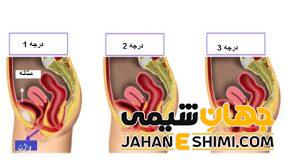 افتادگی مثانه در زنان چیست؟ | دارو و درمان افتادگی مثانه