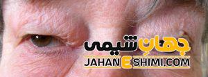 افتادگی پلک چیست؟ | دارو و درمان فوری افتادگی پلک