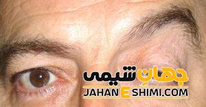 افتادگی پلک چیست؟ | دارو و درمان فوری افتادگی پلک