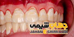 5 دلیل مهم خونریزی لثه چیست ؟ | دارو و درمان فوری خونریزی لثه
